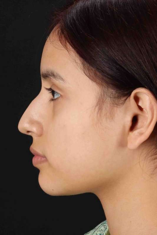 Rhinoplasty Before & After Patient #5903