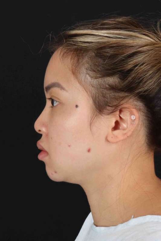 Rhinoplasty Before & After Patient #5914