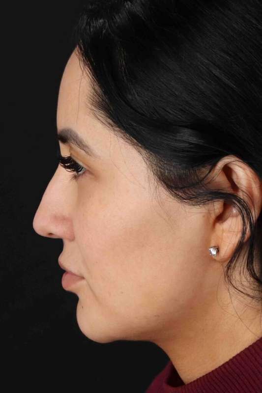 Rhinoplasty Before & After Patient #5925