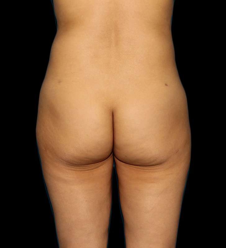 Cosmetic Body Lift Before & After Patient #1186