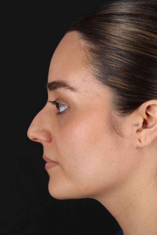 Rhinoplasty Before & After Patient #5947