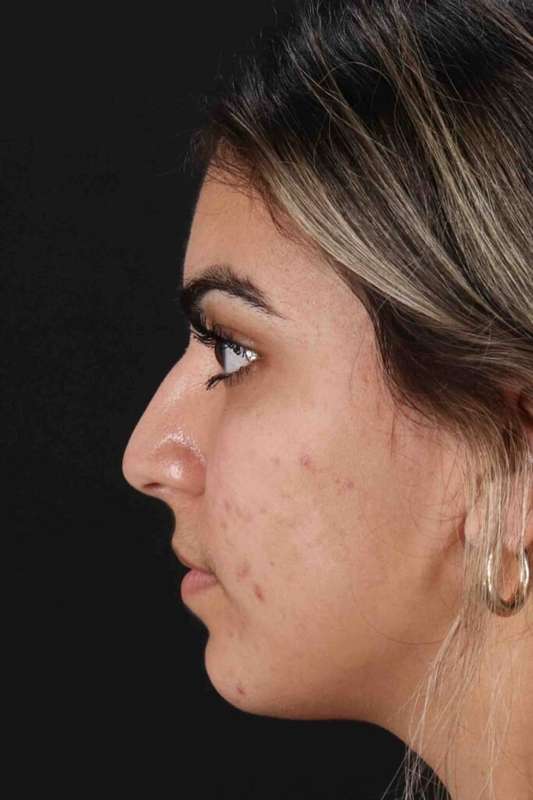 Rhinoplasty Before & After Patient #5958