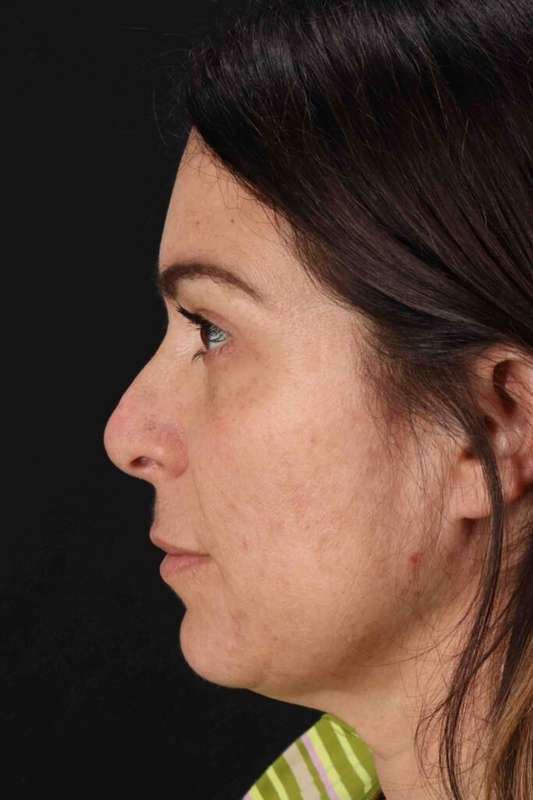 Rhinoplasty Before & After Patient #5969