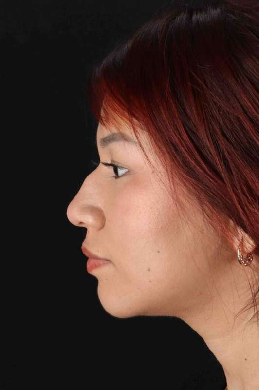 Rhinoplasty Before & After Patient #5983