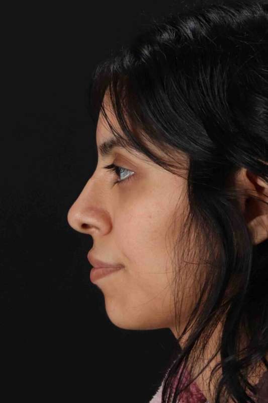 Rhinoplasty Before & After Patient #5994