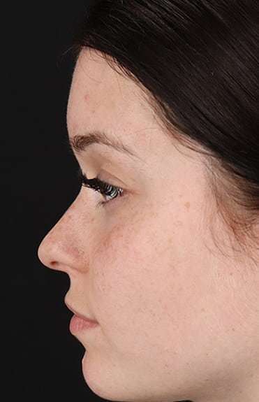 Rhinoplasty Before & After Patient #6178