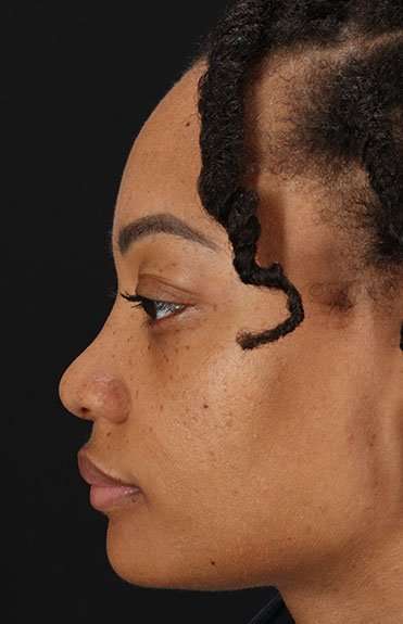 Rhinoplasty Before & After Patient #6189