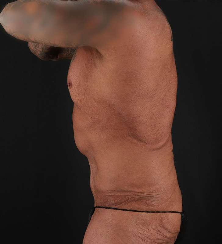 Cosmetic Body Lift Before & After Patient #1200