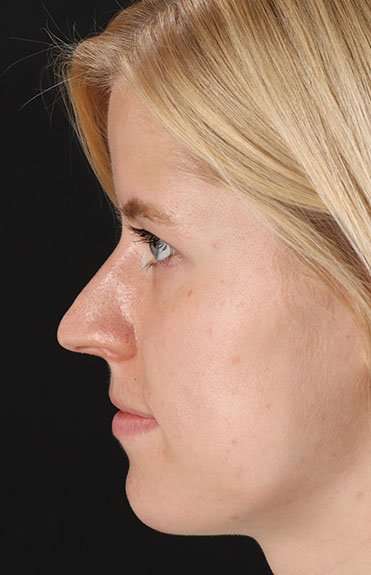 Rhinoplasty Before & After Patient #6200