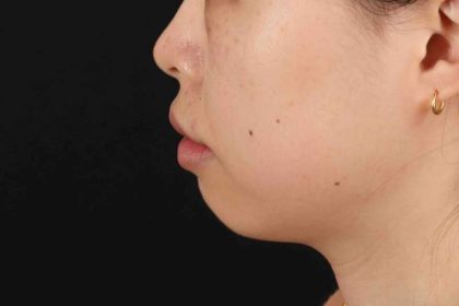Lip Reduction Before & After Patient #6222