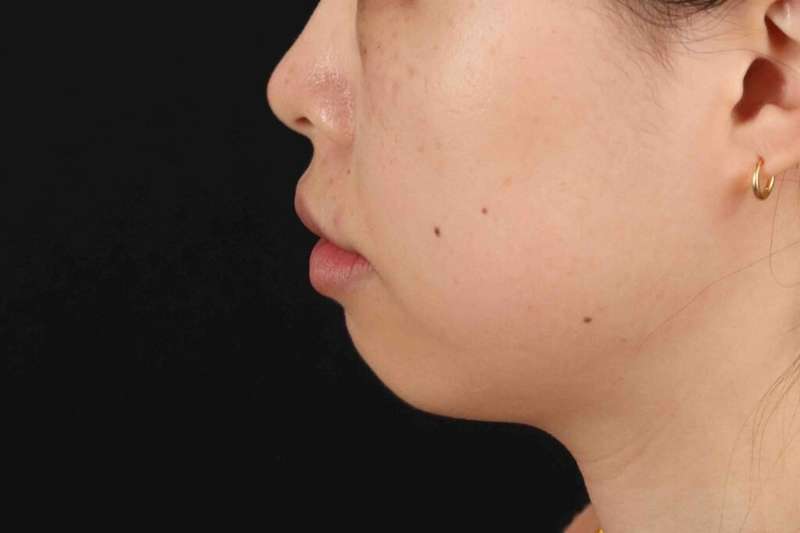 Lip Reduction Before & After Patient #6222