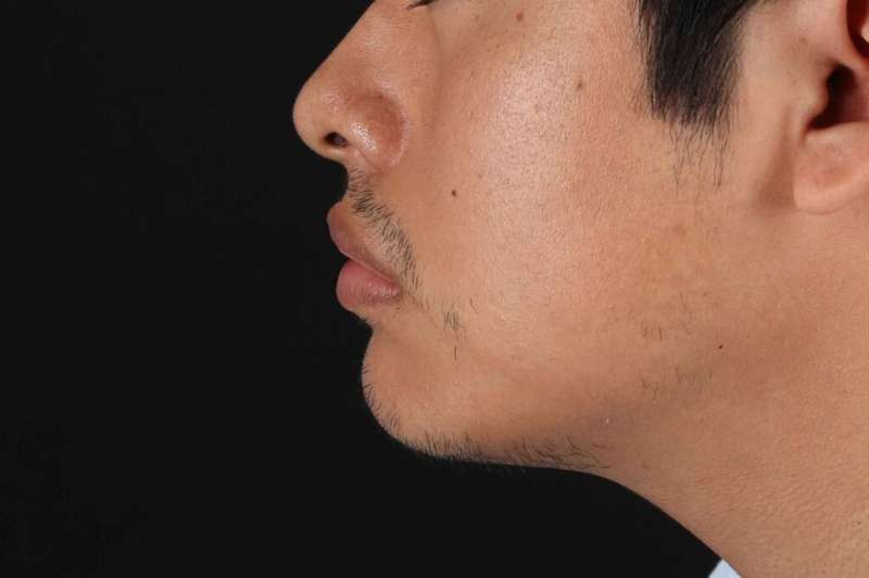 Lip Reduction Before & After Patient #6233