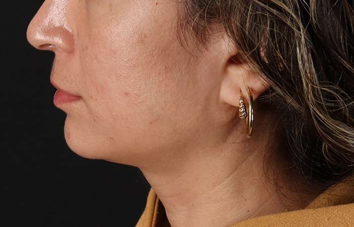Lip Lift Before & After Patient #6244