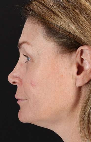 Lip Lift Before & After Patient #6266