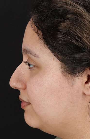 Liquid Rhinoplasty Before & After Patient #6299