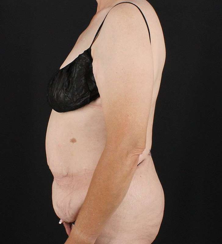 Cosmetic Body Lift Before & After Patient #1218