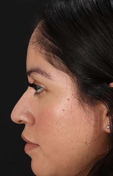 Liquid Rhinoplasty Before & After Patient #6319