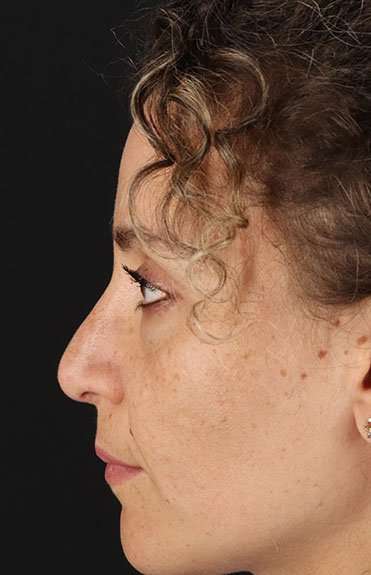 Liquid Rhinoplasty Before & After Patient #6333