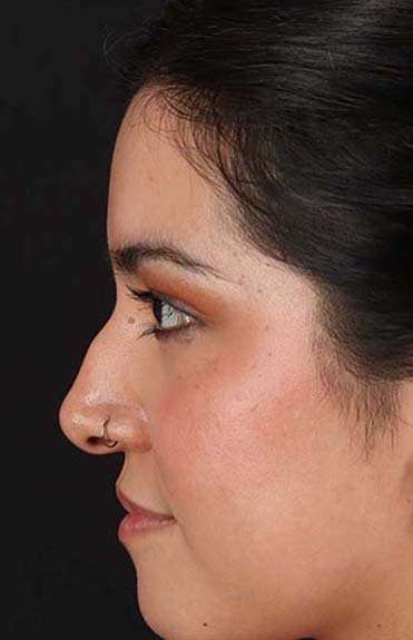 Liquid Rhinoplasty Before & After Patient #6344