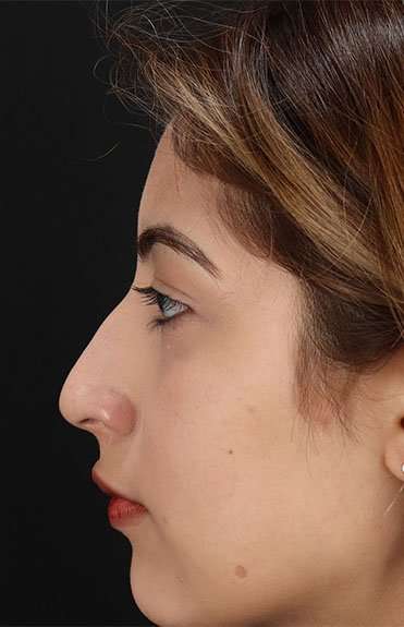 Liquid Rhinoplasty Before & After Patient #6355