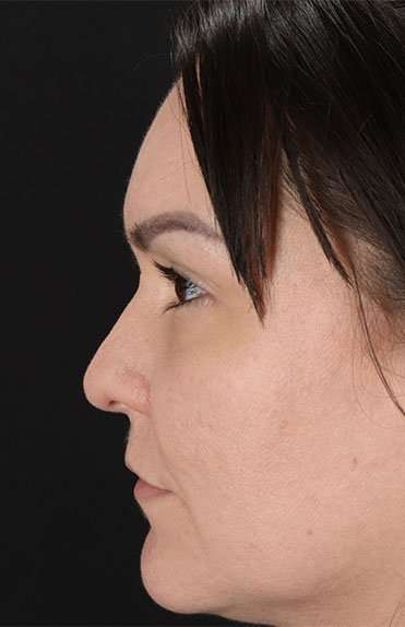 Liquid Rhinoplasty Before & After Patient #6366