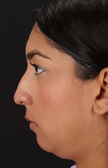 Liquid Rhinoplasty Before & After Patient #6377