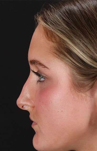 Liquid Rhinoplasty Before & After Patient #6388