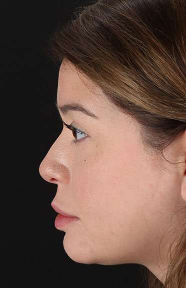 Liquid Rhinoplasty Before & After Patient #6399
