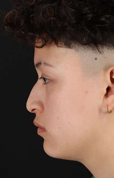 Liquid Rhinoplasty Before & After Patient #6410