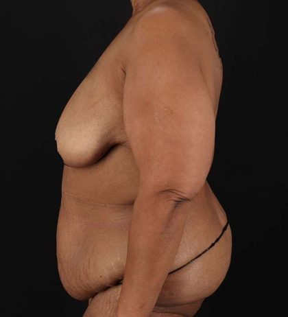 Cosmetic Body Lift Before & After Patient #1234