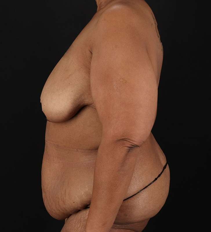 Cosmetic Body Lift Before & After Patient #1234