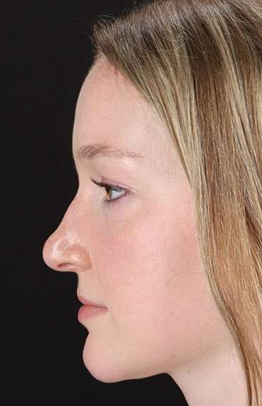 Liquid Rhinoplasty Before & After Patient #6425