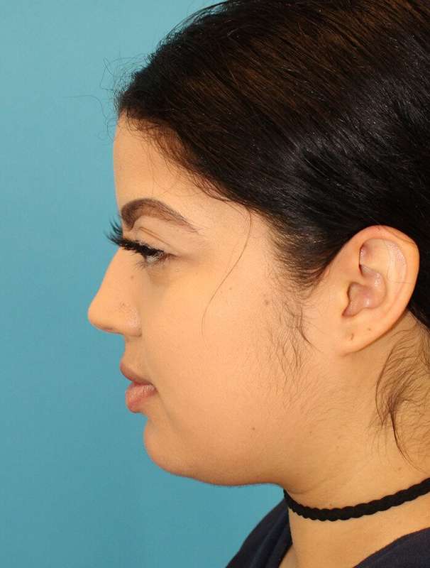 Buccal Fat Pad Before & After Patient #6436