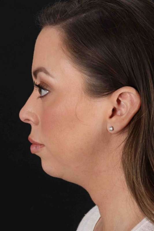 Buccal Fat Pad Before & After Patient #6474