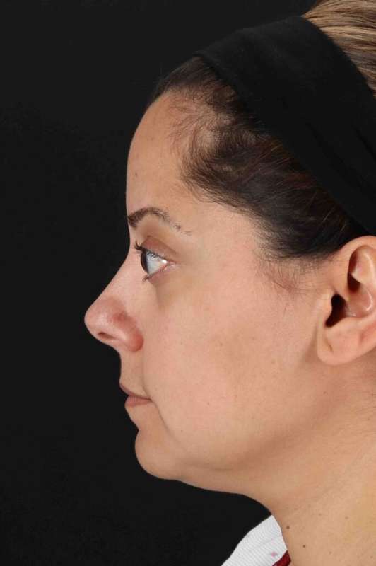Buccal Fat Pad Before & After Patient #6485