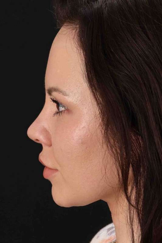 Buccal Fat Pad Before & After Patient #6496