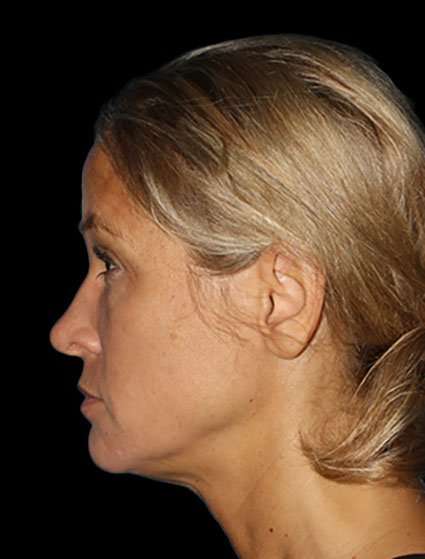 Neck Lift Before & After Patient #6517