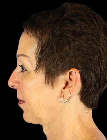 Neck Lift Before & After Patient #6528