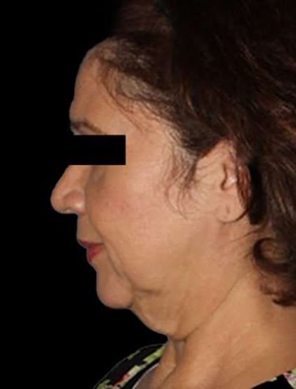 Neck Lift Before & After Patient #6539