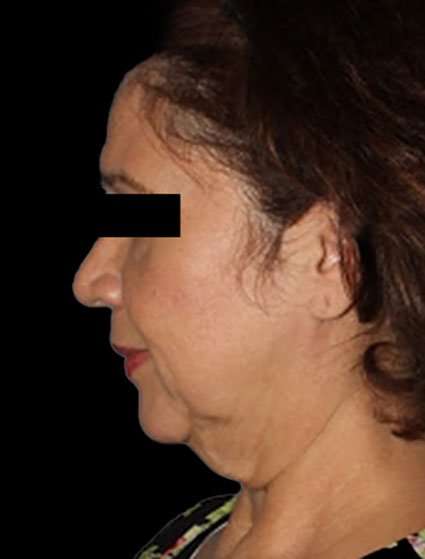 Neck Lift Before & After Patient #6539
