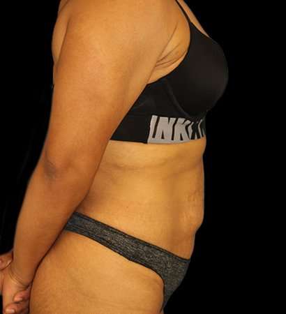 Abdominoplasty (Tummy Tuck) Before & After Patient #601