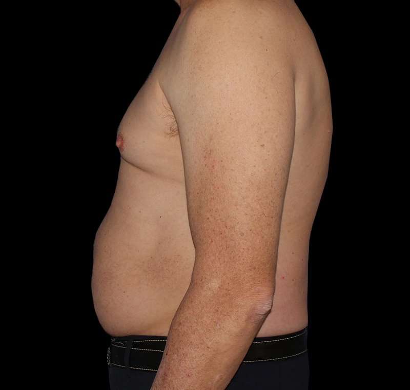 Liposuction Before & After Patient #1270