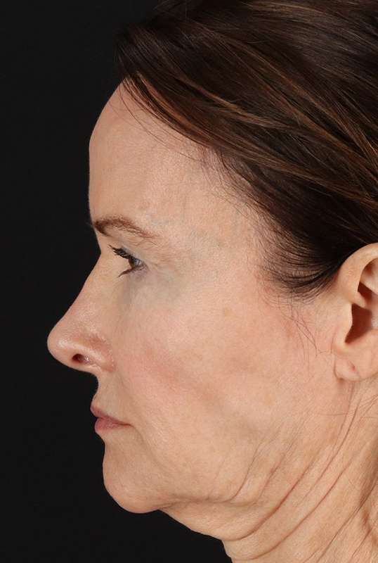 Neck Lift Before & After Patient #6631