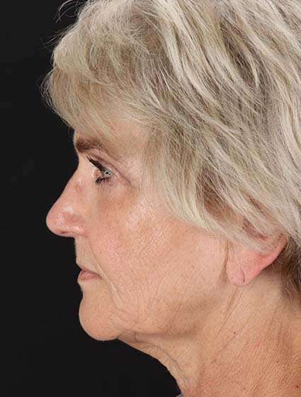 Neck Lift Before & After Patient #6654