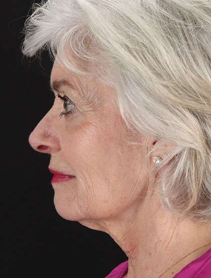 Neck Lift Before & After Patient #6665