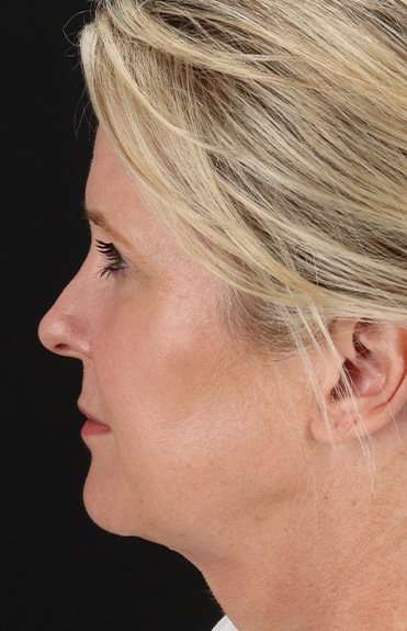 Neck Lift Before & After Patient #6720