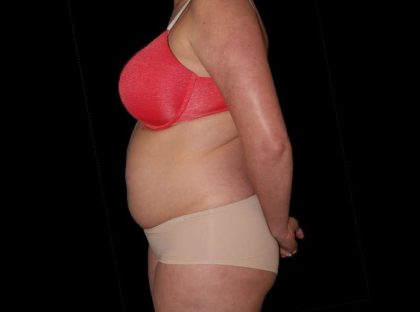 Liposuction Before & After Patient #1298