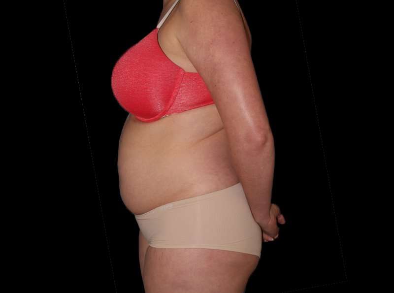 Liposuction Before & After Patient #1298