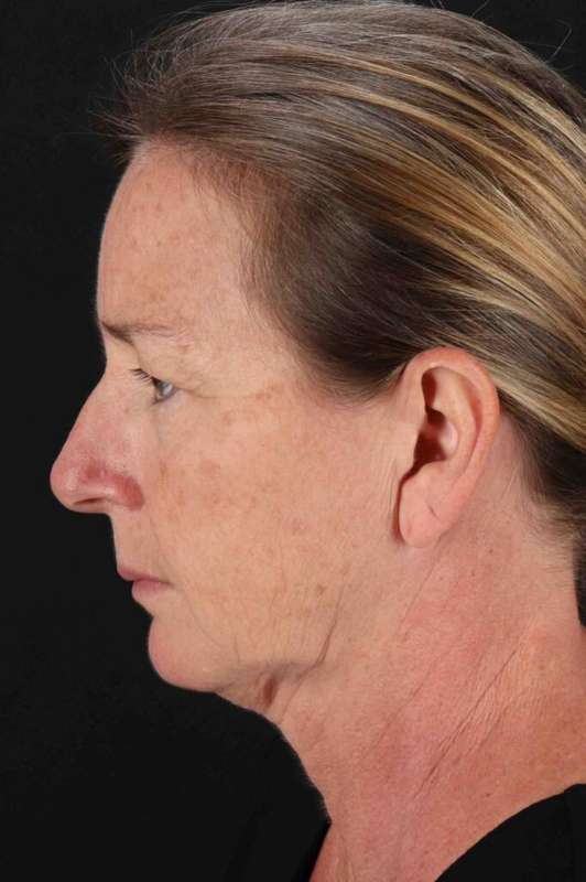 Neck Lift Before & After Patient #6777