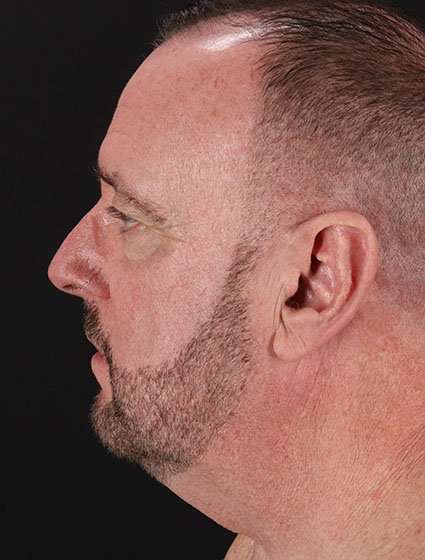 Neck Lift Before & After Patient #6856